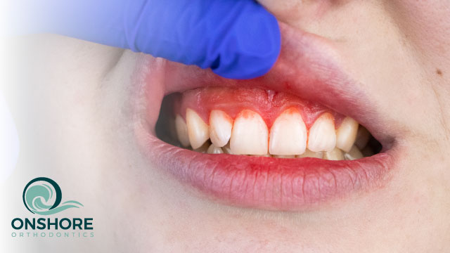 Swollen Gums with Braces: Causes and Treatments