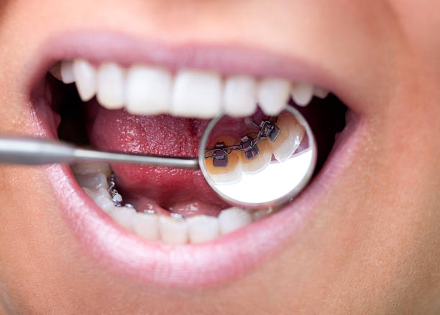 lingual braces near me