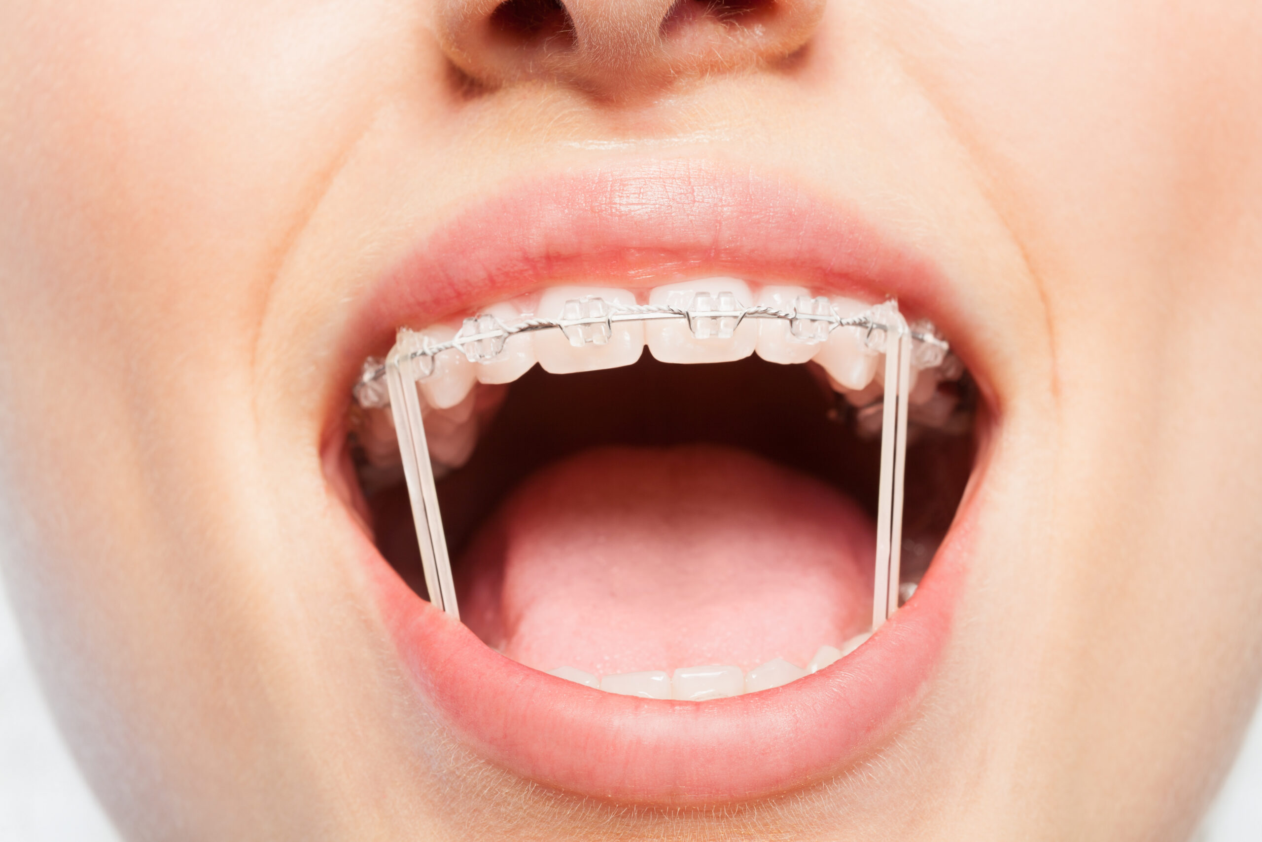 braces orthodontist in Yulee FL